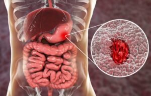 peptic ulcers